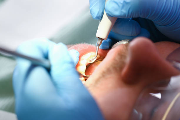 Best Emergency Gum Treatment in Santa Cruz, CA