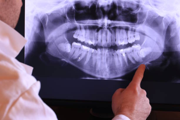 Best Emergency Treatment for Dental Infections or Abscesses in Santa Cruz, CA